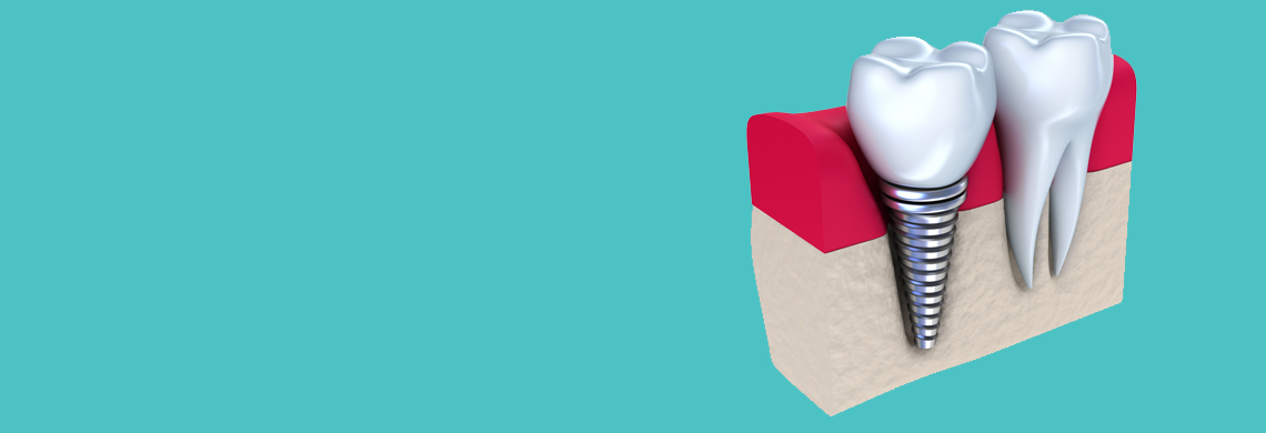 Dental Implants