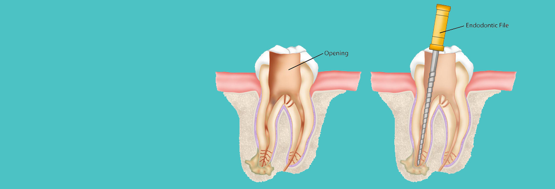 Root Canal Treatment